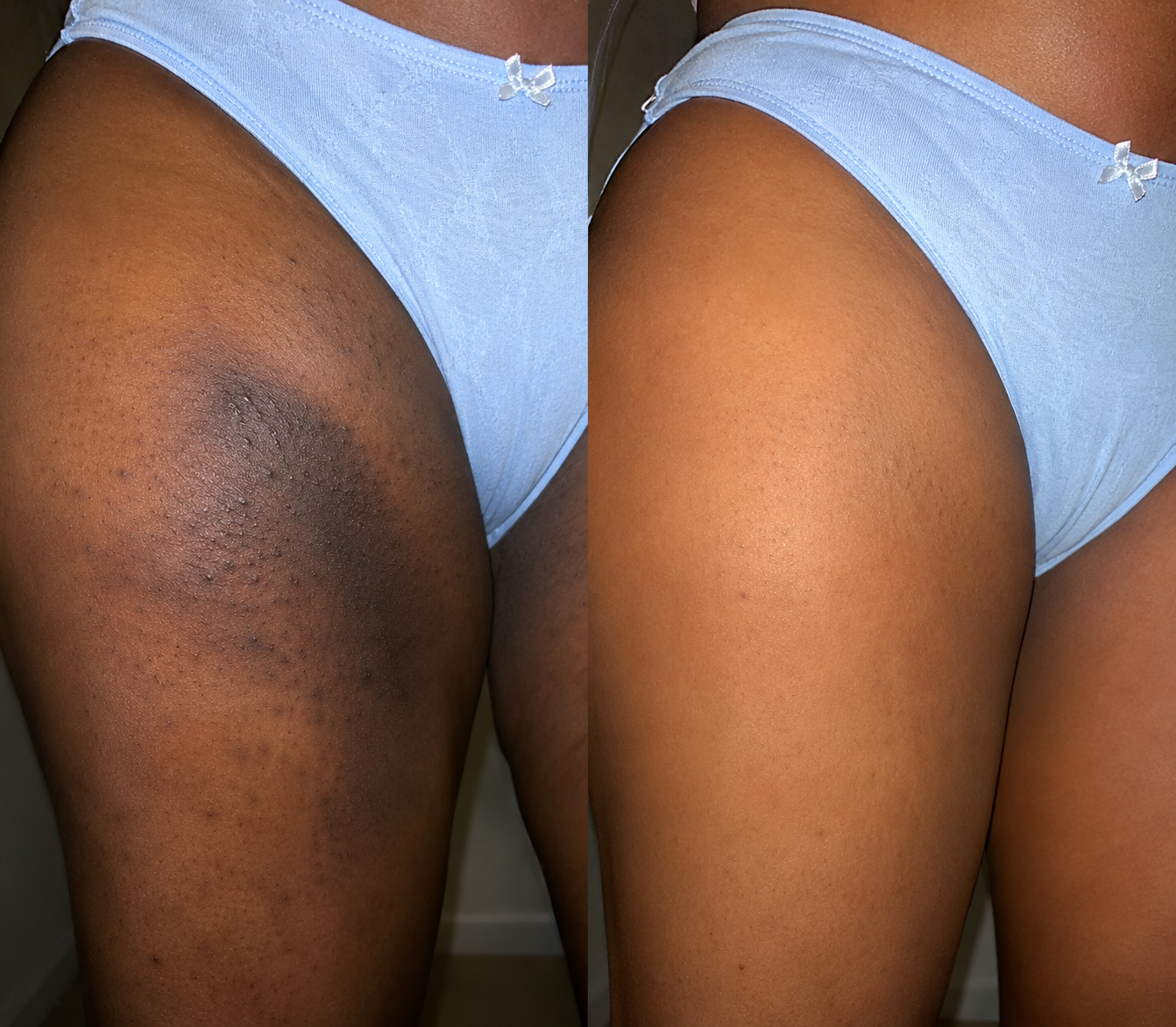 Inner thigh before and after 90 days