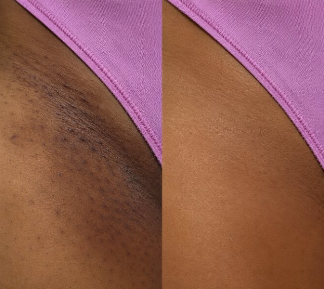 Bikini and inner thigh before and after 90 days