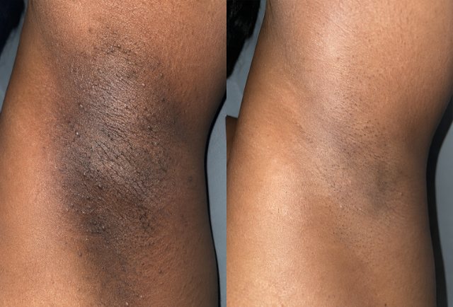 Underarms before and after 90 days