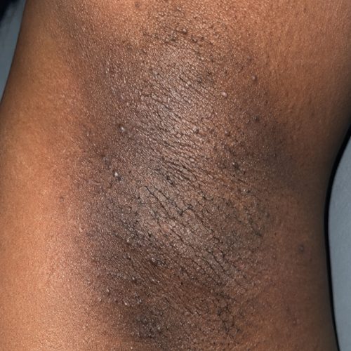Close-up of bumpy, hyperpigmented skin from friction and ingrown hairs
