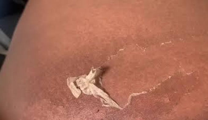 Chemical peel burn causing skin to peel